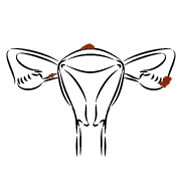 endrometriosis